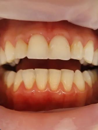 Dentes antes do clareamento