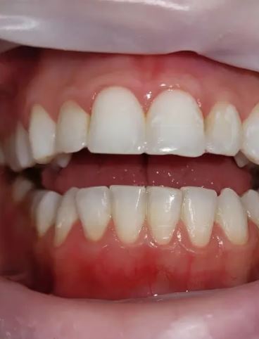 Dentes depois do clareamento