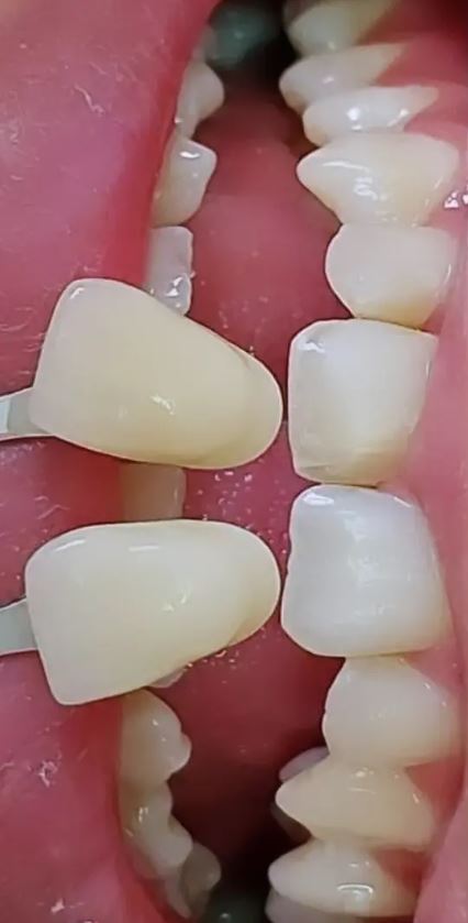Dentes na escala de cor antes do clareamento
