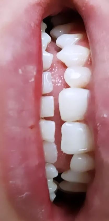 Dentes mais claros depois do tratamento