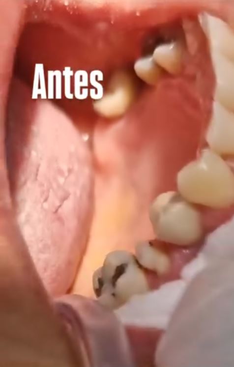 Dentes antes das restaurações