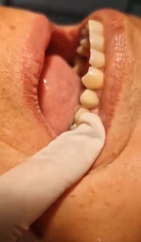 Dentes depois das restaurações